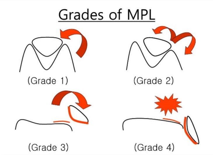 grading of patella luxation2 (730 x 532)